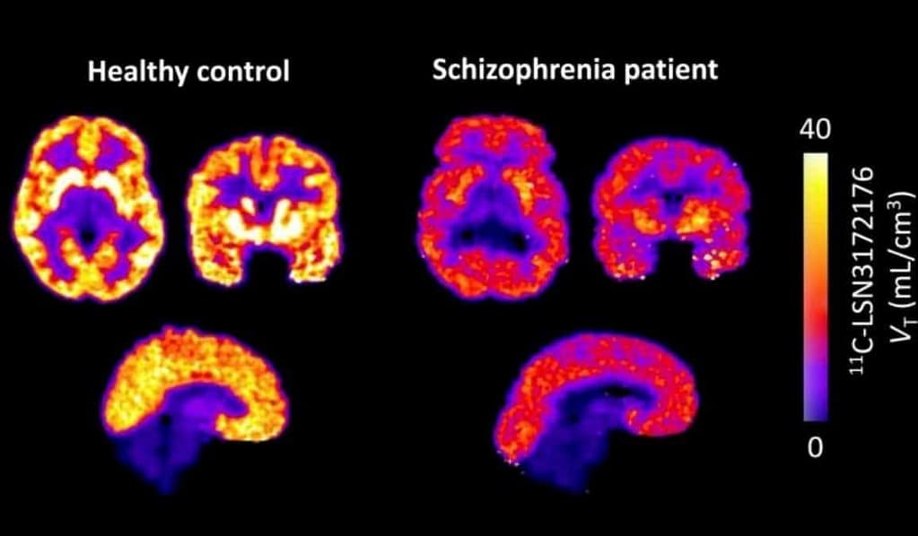 Widespread M1 Receptor Deficits in Schizophrenia Found widespread m1 receptor deficits in schizophrenia found