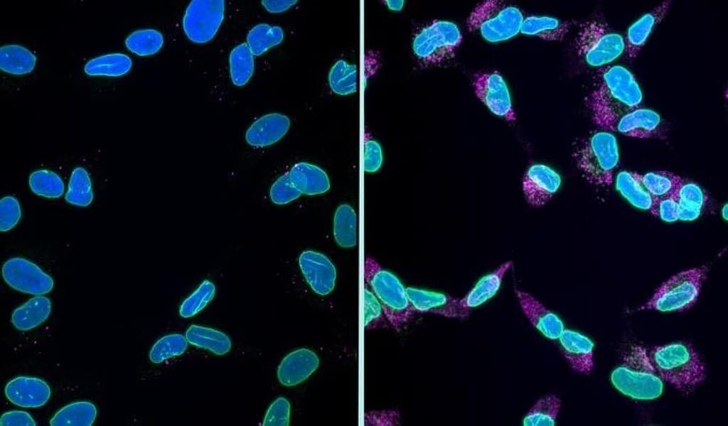 New Form of Cell Death Discovered in Alzheimer’s new form of cell death discovered in alzheimer’s