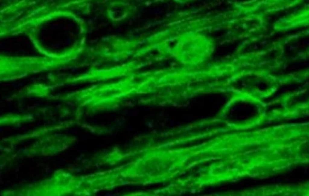 Hidden Dynamics of Early Multiple Sclerosis Myelin Damage hidden dynamics of early multiple sclerosis myelin damage