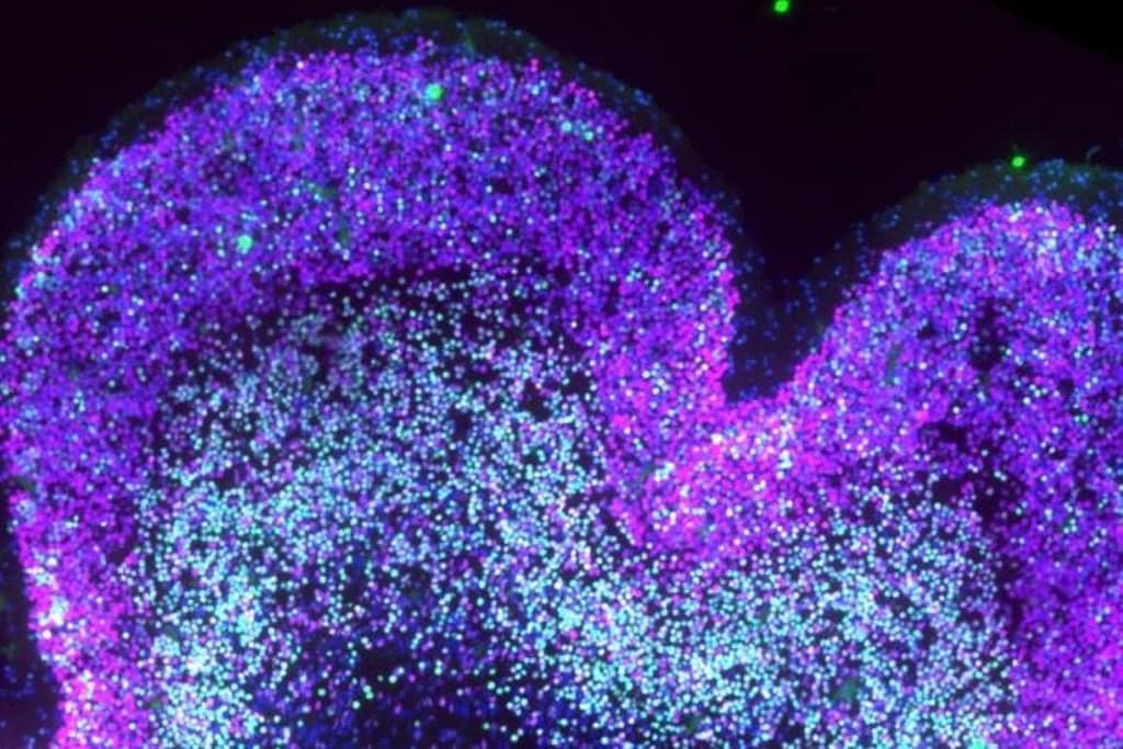 How Down Syndrome Reshapes the Developing Brain how down syndrome reshapes the developing brain