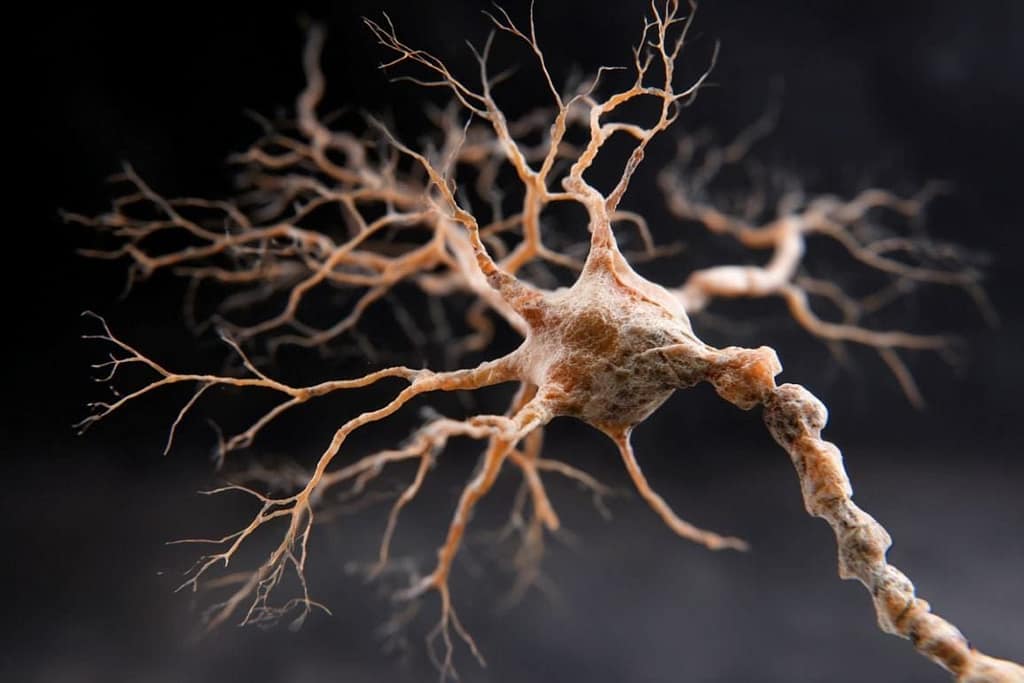 Alzheimer’s Risk Gene May Drive Aggressive ALS alzheimer’s risk gene may drive aggressive als
