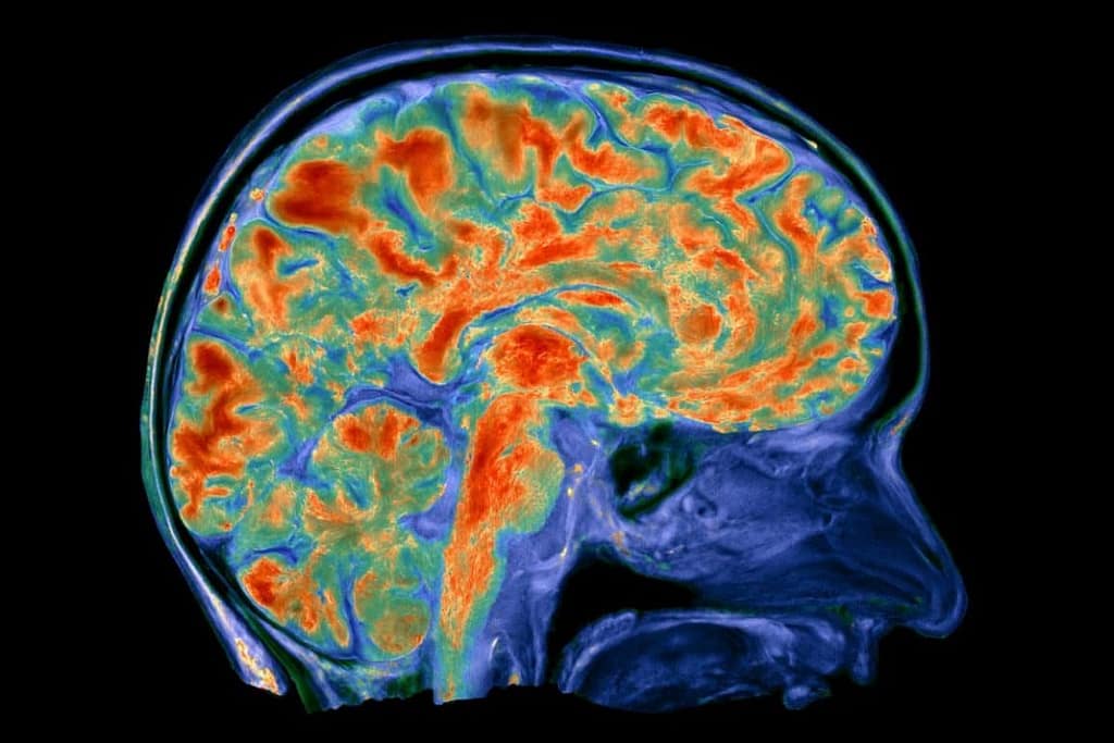 Brain PET Scans Link Late-Onset Psychosis to Tau and Amyloid brain pet scans link late onset psychosis to tau and amyloid